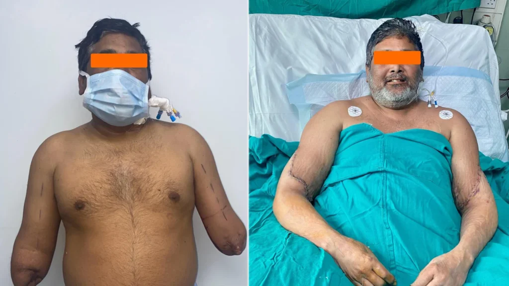 Delhi Painter receives Hands Back As Organ Donation Meets Surgical Excellence