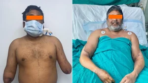 Delhi Painter receives Hands Back As Organ Donation Meets Surgical Excellence