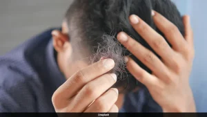 Arthritis Drug Helps Restore Hair In People With Severe Alopecia: Study