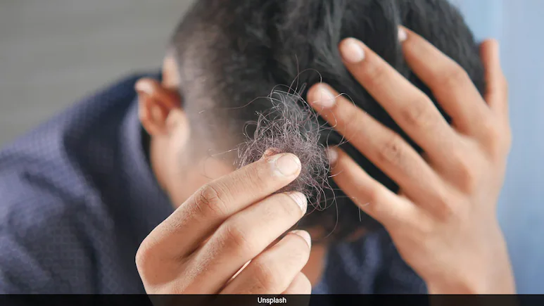 Arthritis Drug Helps Restore Hair In People With Severe Alopecia: Study