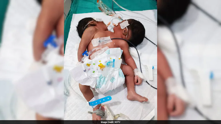 Conjoined Twins With 2 Heads, 1 Torso Die Week After Birth At Odisha Hospital: the facts and wider