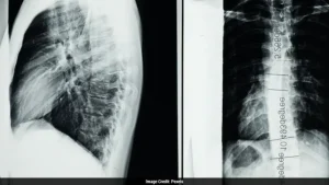 World's First Spinal Cord Transplant Performed On Paralysed Patient In Russia