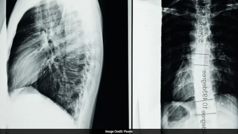 World's First Spinal Cord Transplant Performed On Paralysed Patient In Russia